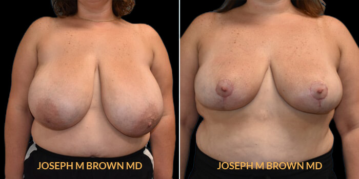 Patient 01 Front Side View Breast Reduction Tampa Aesthetic & Plastic Surgery