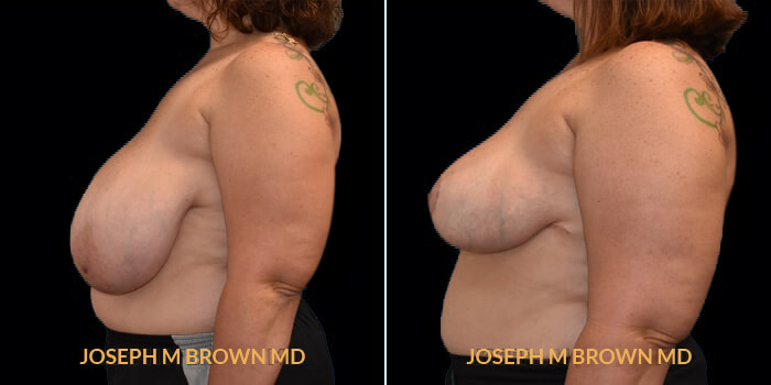 Patient 01 Left Side View Breast Reduction Tampa Aesthetic & Plastic Surgery