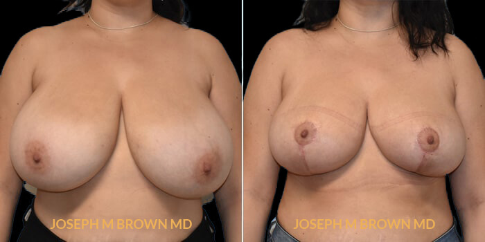 Patient 03 Front Side View Breast Reduction Tampa Aesthetic & Plastic Surgery