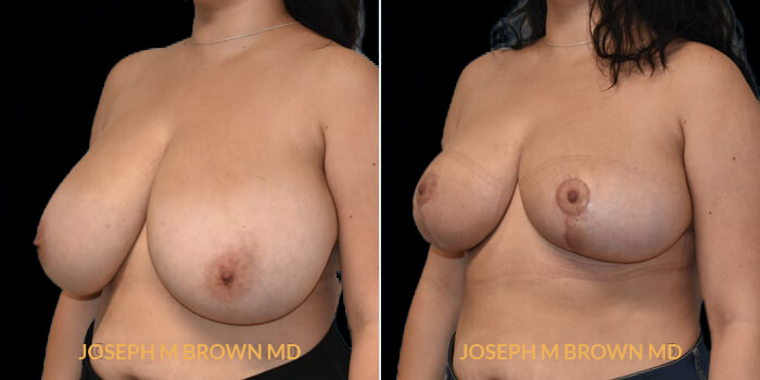 Patient 03 3/4th Left Side View Breast Reduction Tampa Aesthetic & Plastic Surgery