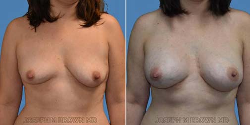 Breast Asymmetry before after pictures Gallery