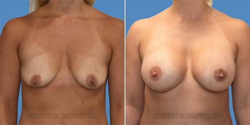 Breast Augmentation before after pictures Gallery