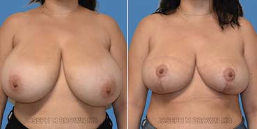 Breast Reduction before after picture of a patient