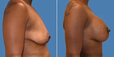 Breast Lift before after picture of a patient