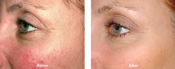 Laser Genesis Before and After 1 Dr Milan Lombardi
