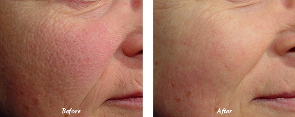 Laser Genesis Before and After 2 Dr Milan Lombardi