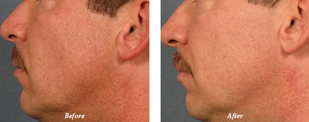 Laser Genesis Before and After 3 Dr Milan Lombardi