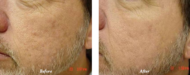 Laser Genesis Before and After 8 Dr Milan Lombardi