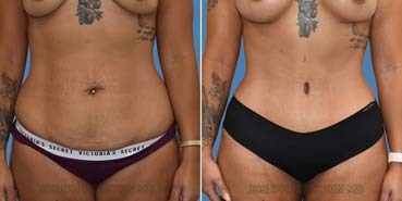 Tummy Tuck before after picture of a patient